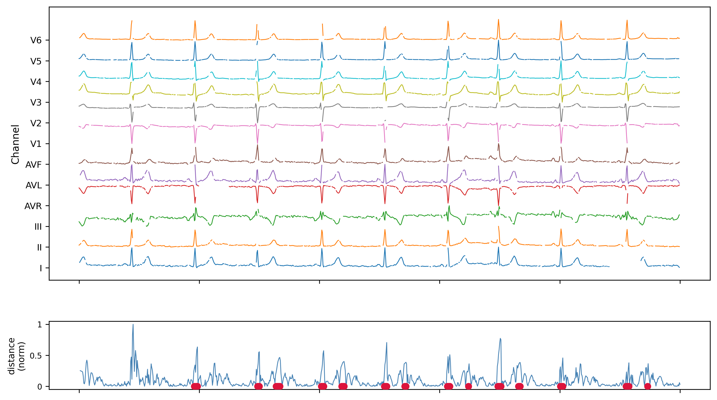 12-lead ECG with HiAD internal distance and detected anomaly markers (noisy)